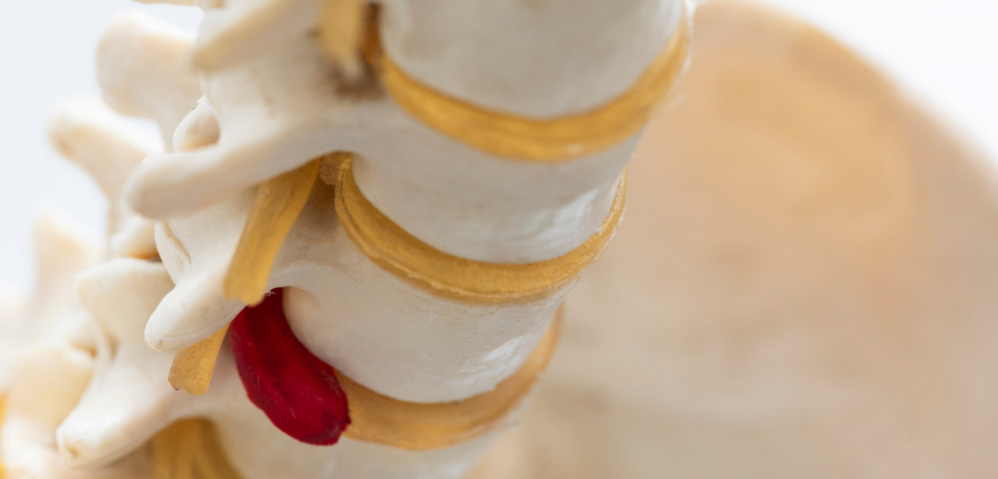 Hernia de disc: cum tratează medicina modernă durerea și mobilitatea afectată