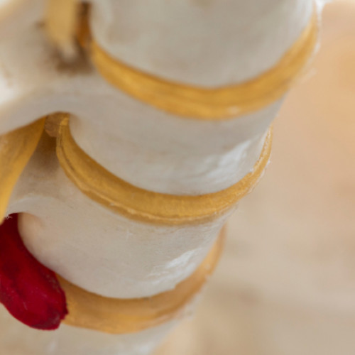 Hernia de disc: cum tratează medicina modernă durerea și mobilitatea afectată